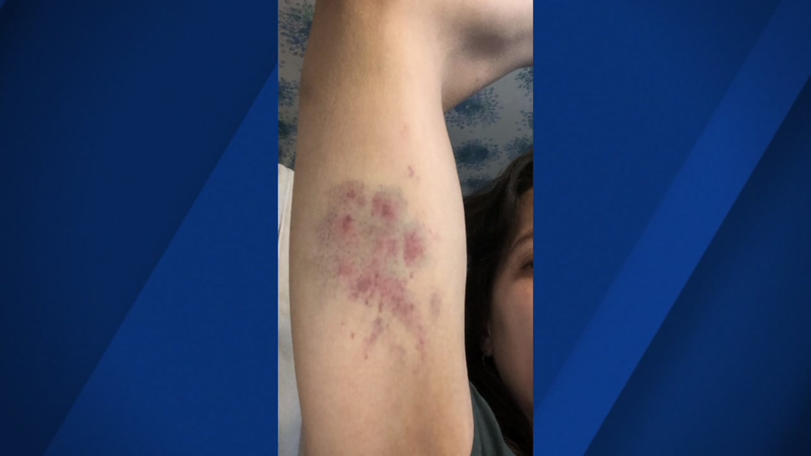 No charging decision yet in dispute over jogger bite in Oakland Hills