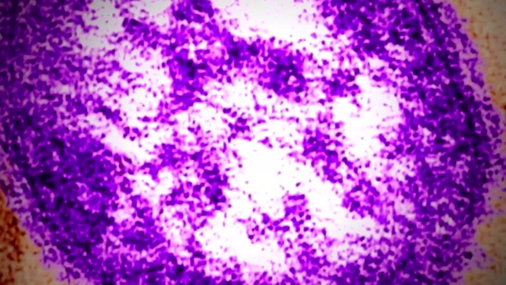 5 measles cases in Harris, Montgomery and Galveston counties