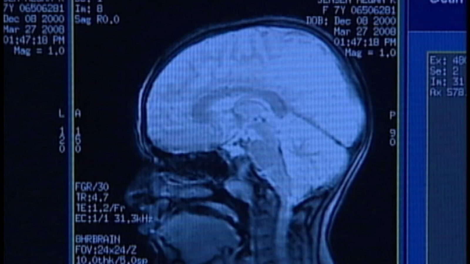Female brains age slower than men's, study says - ABC7 Los Angeles