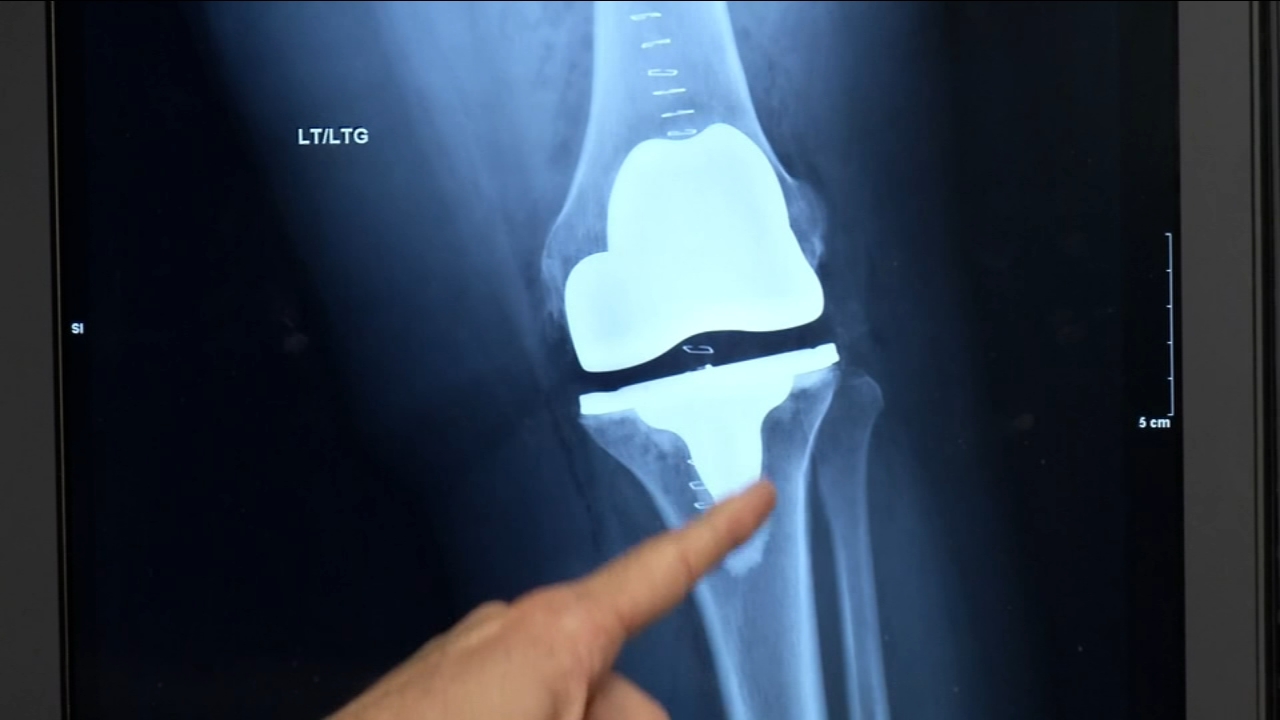 Need That Knee Replacement?