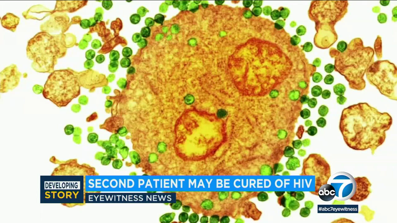 AIDS breakthrough: Second man appears free of AIDS virus after transplant