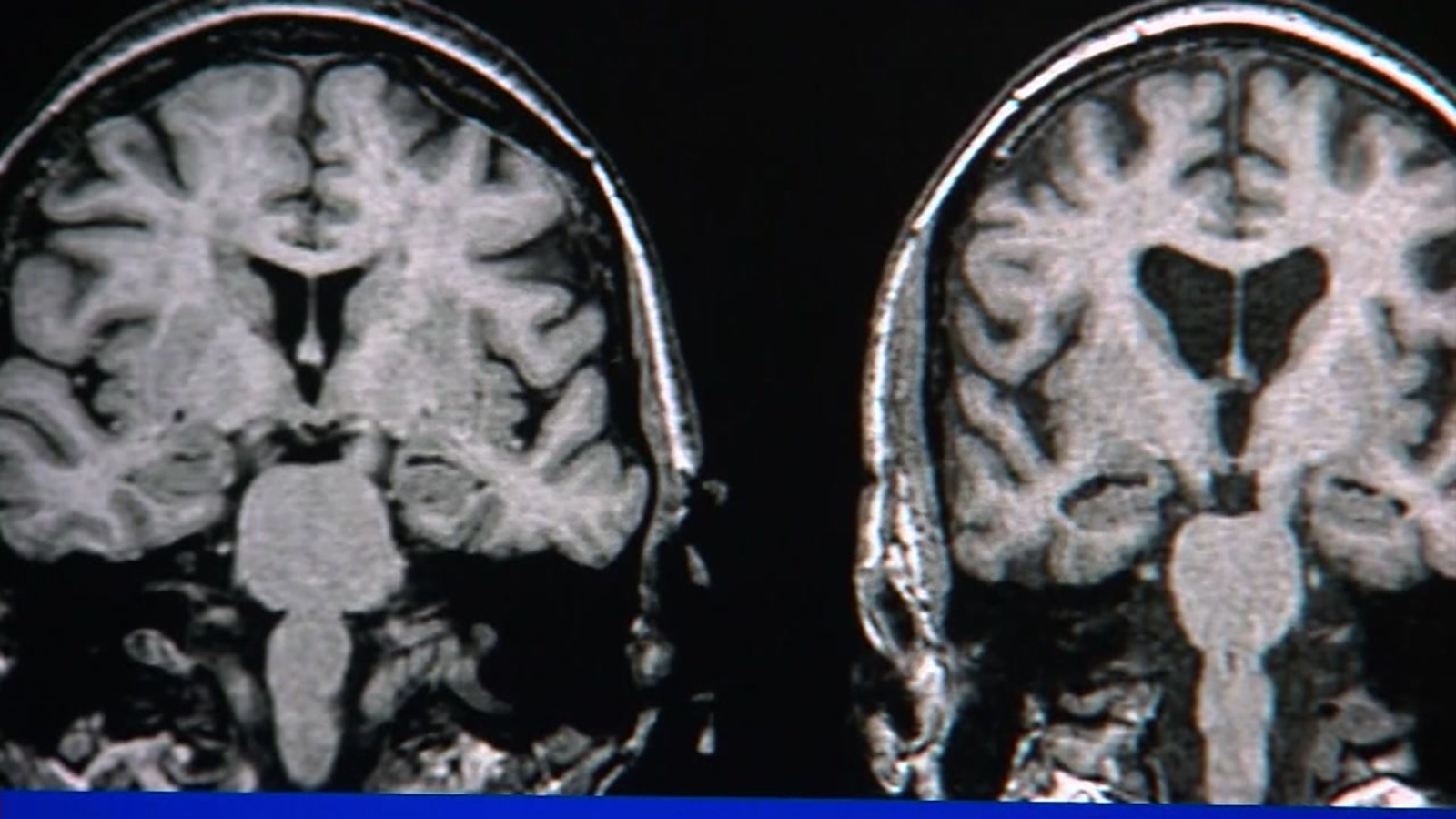 Routine eye exam could one day diagnose Alzheimer's disease before