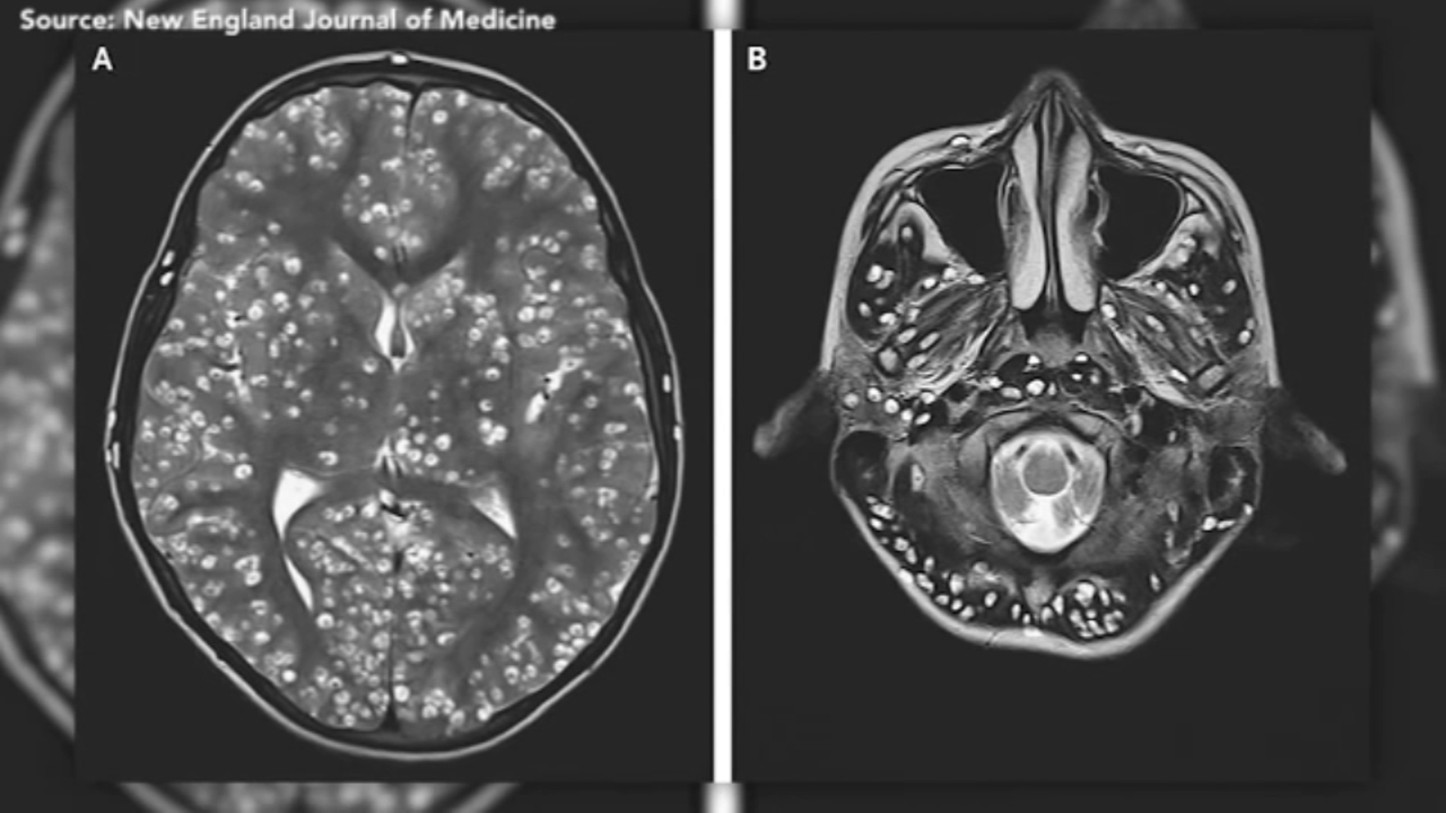 Teen dies of tapeworm egg infestation in brain - ABC7 San Francisco