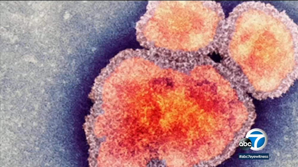 Measles quarantines issued at UCLA, Cal State LA