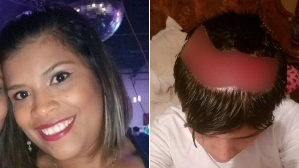 Woman suing salon over permanent scalp burns