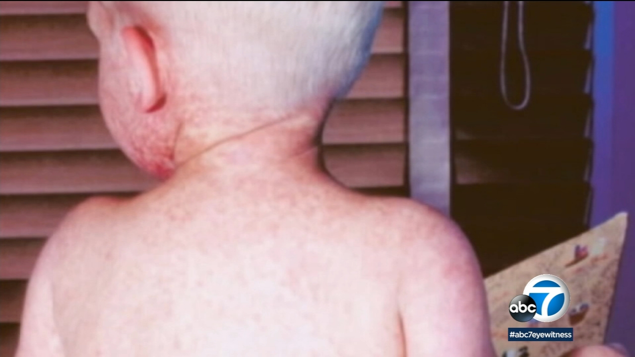 Measles outbreak: L.A. County among highest-risk areas for measles in country, study says