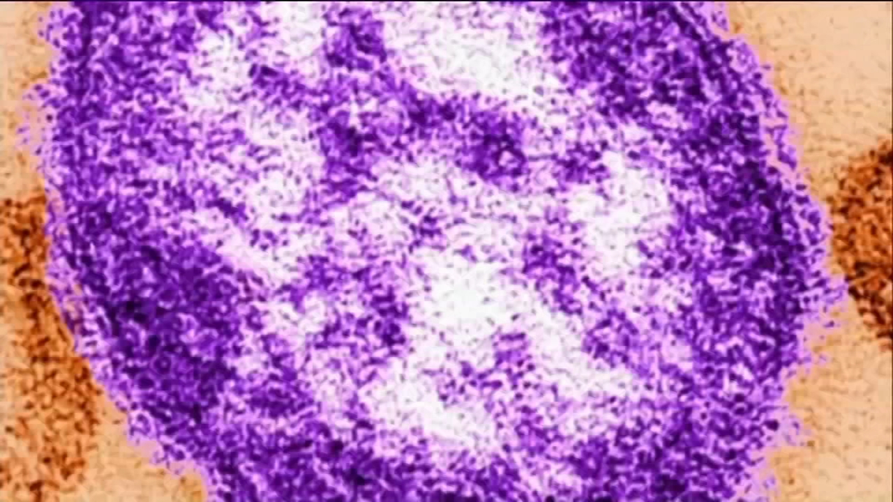 Confirmed measles case in Chicago, officials release new details