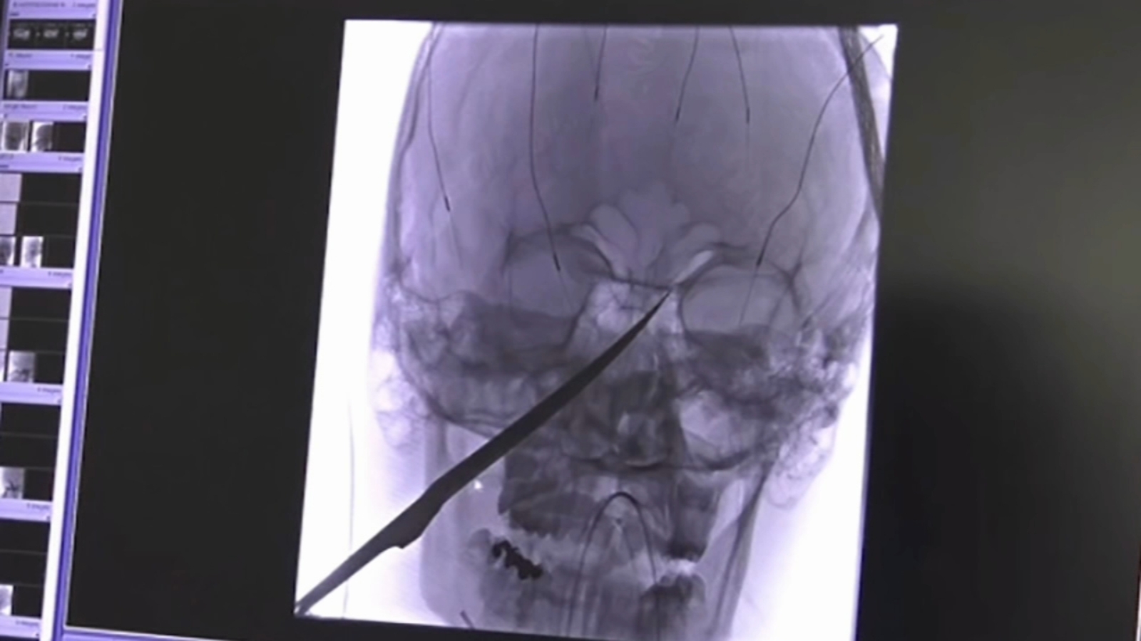 Kansas teen Eli Gregg impaled in face by 10inch knife after falling on