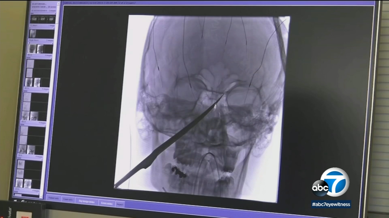 Boy miraculously survives 10-inch knife being lodged in his skull