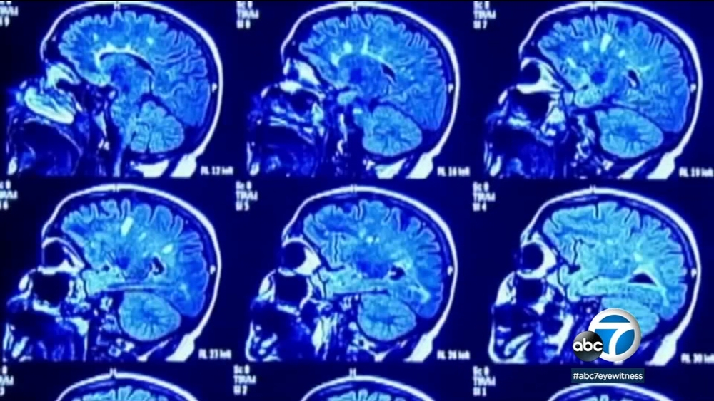 Working long hours increases risk of stroke by 45 percent, new study says
