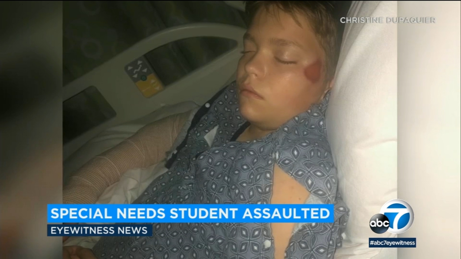 Mom says her special needs son had his elbow broken and dislocated by a ...