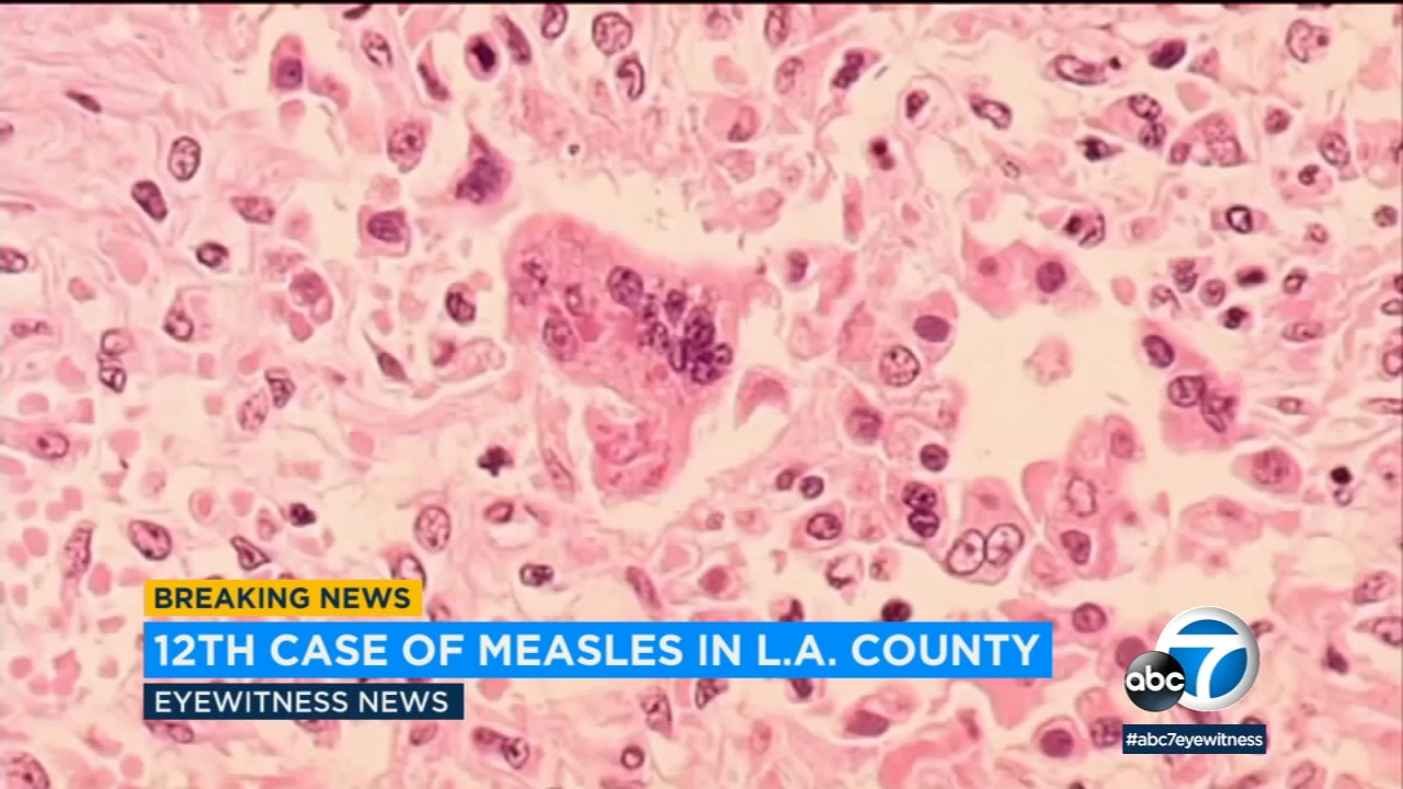 12th measles case reported in L.A. County