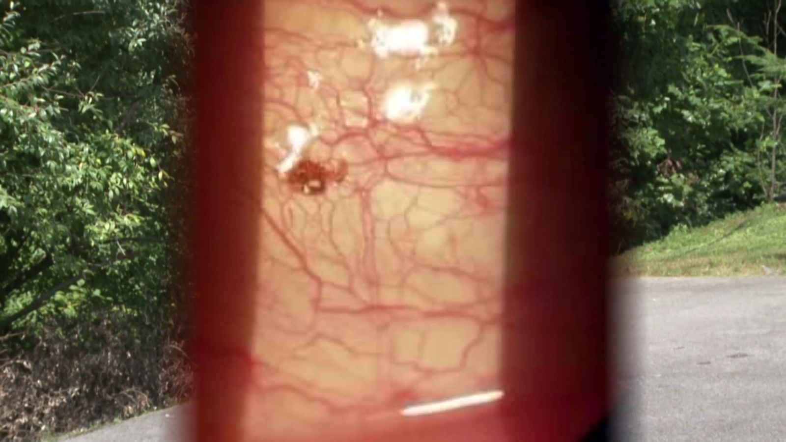 Kentucky man shocked to find deer tick latched on to his eyeball ABC7(02)