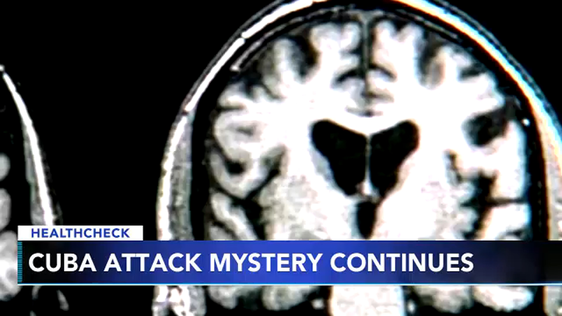 Scans Show Possible Link Between Brain >> Diplomats Brain Scans Show Differences Add To Cuba Mystery Scans Show Possible Link Between Brain >> Diplomats Brain Scans Show Differences Add To Cuba Mystery