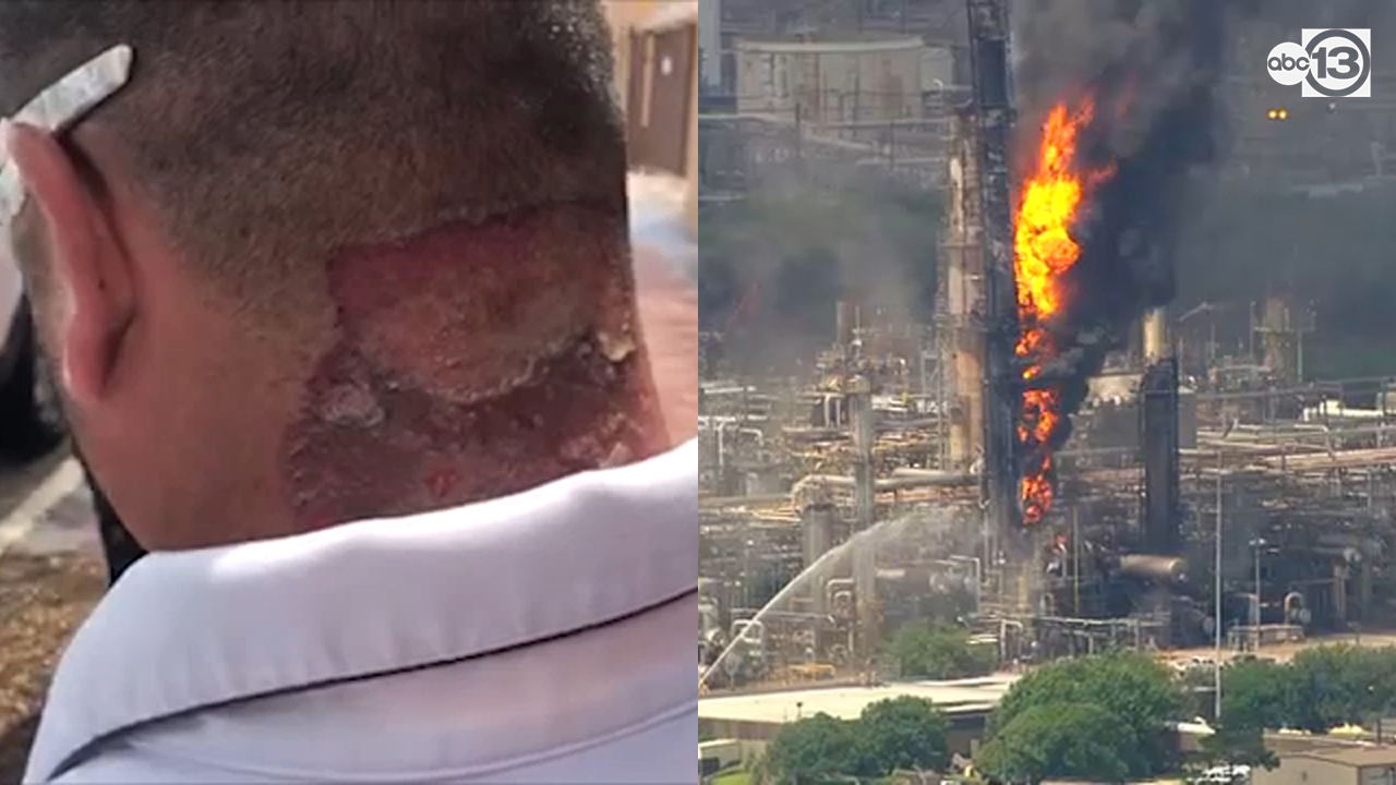 Worker says ExxonMobil clinic dismissed injury as 'sun burns'