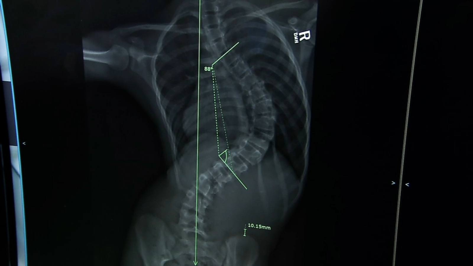 Kids Health Matters Getting back in the game after scoliosis surgery