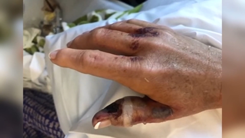 Woman Says She Contracted Flesh Eating Bacteria From Nail Salon In Tennessee Abc13 Houston