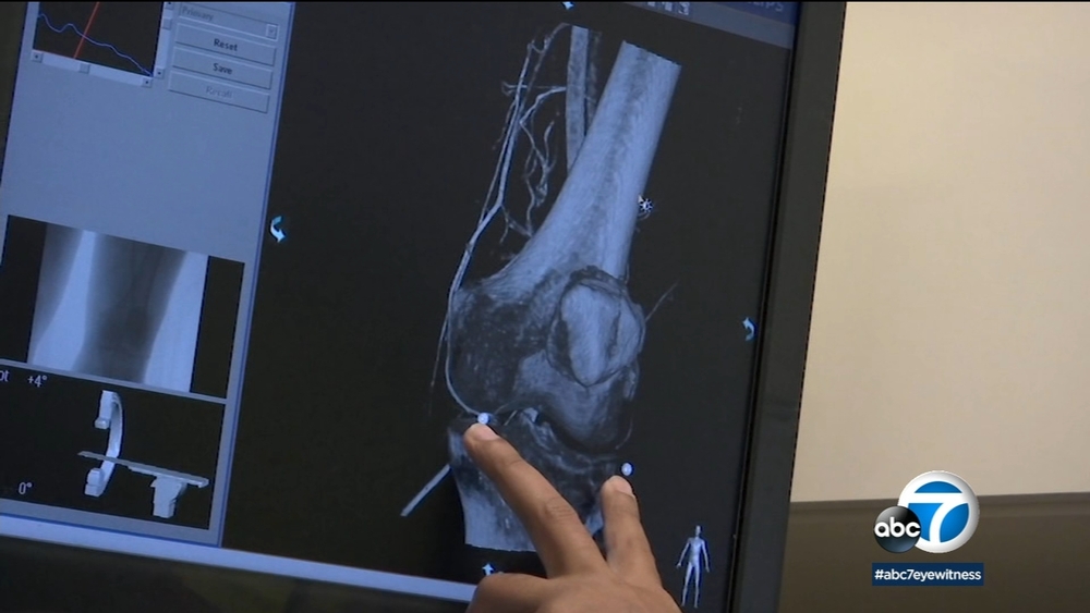 UCLA doctors offer new pinhole procedure to treat osteoarthritis of the knee