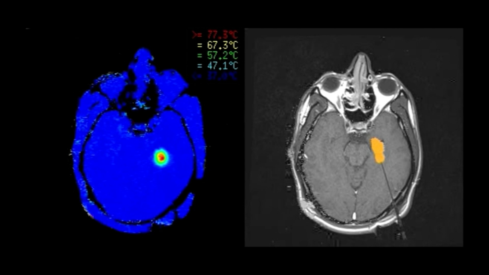 Health Watch Laser ablation to control seizures ABC30 Fresno