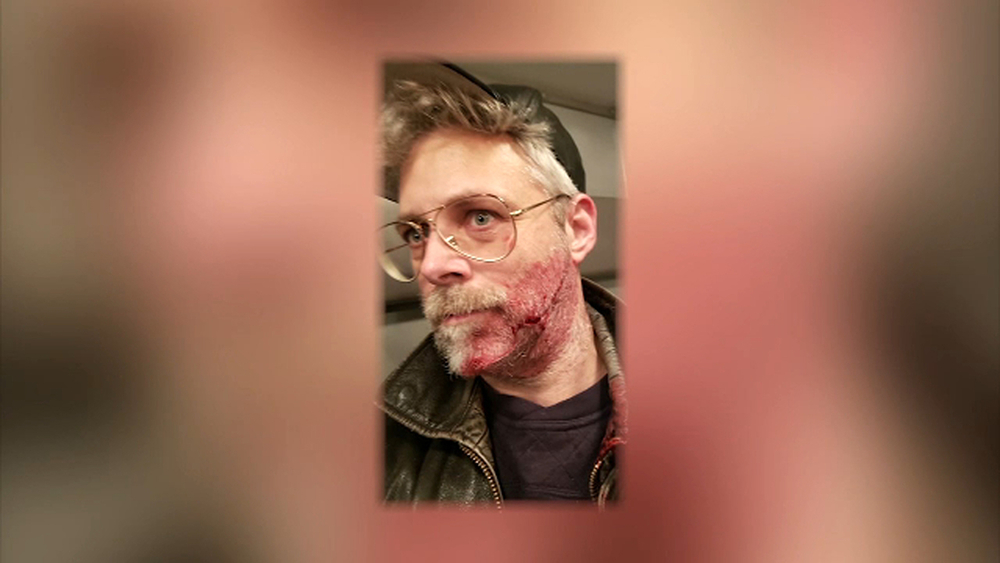 Man slashed in the face after trying to break up fight on the subway