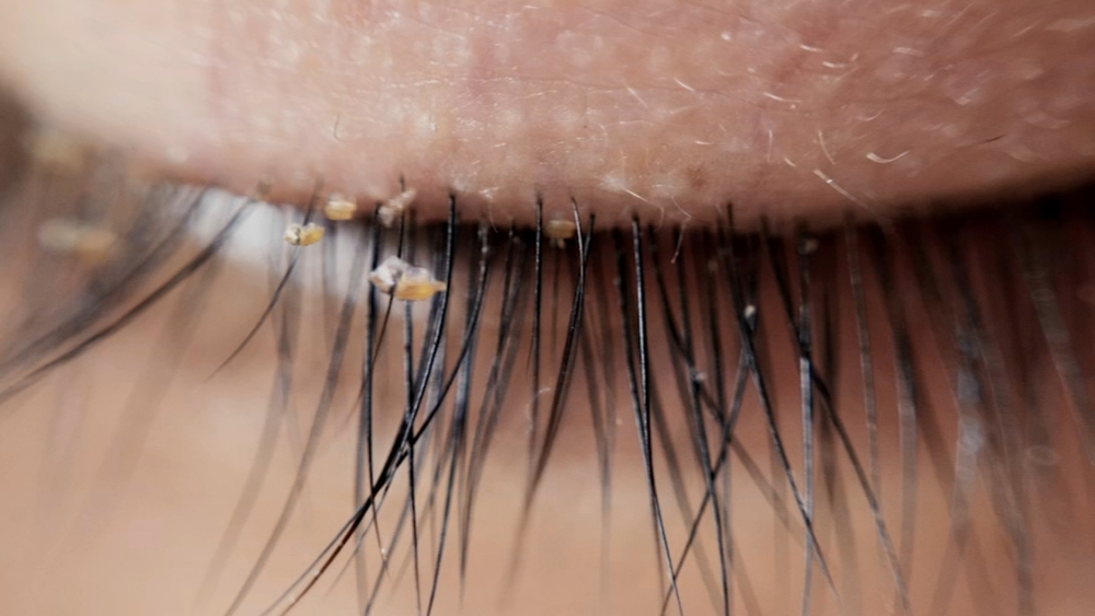 Rise in lash lice cases due to eyelash extensions
