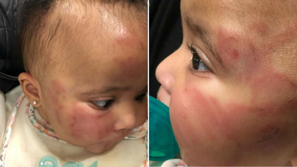 Baby comes home bruised after falling down stairs at unlicensed New Jersey day care, mom says