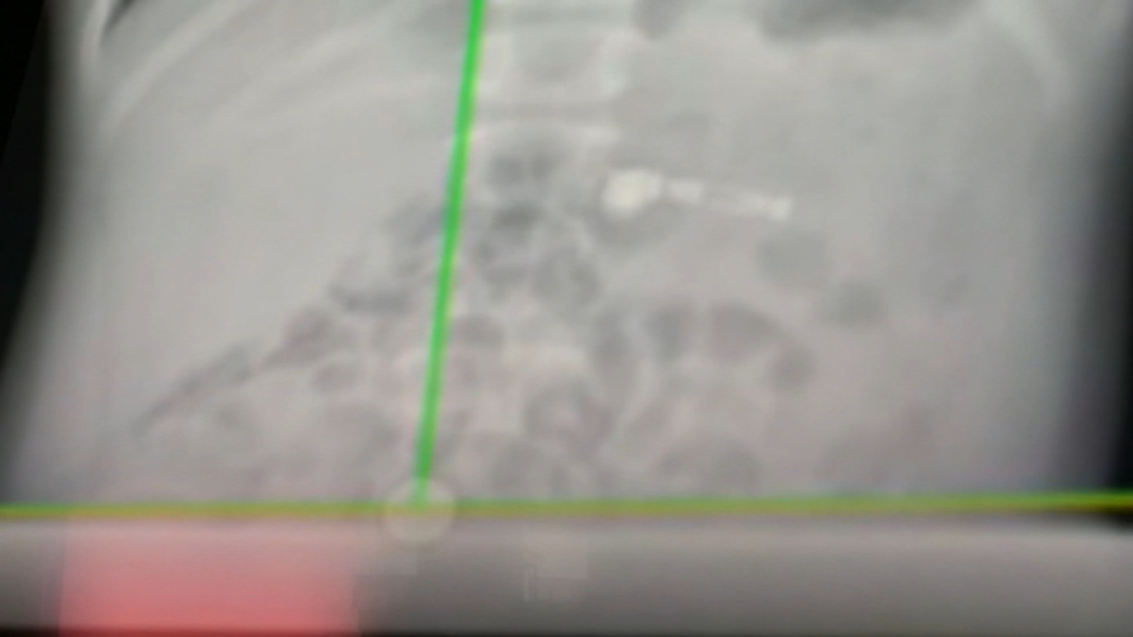 Boy swallows AirPod, rushed to Children's Healthcare of Atlanta