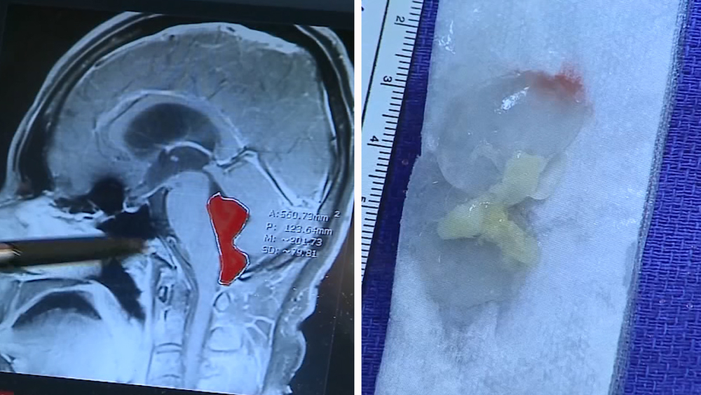 Doctors remove tapeworm from Austin man's brain