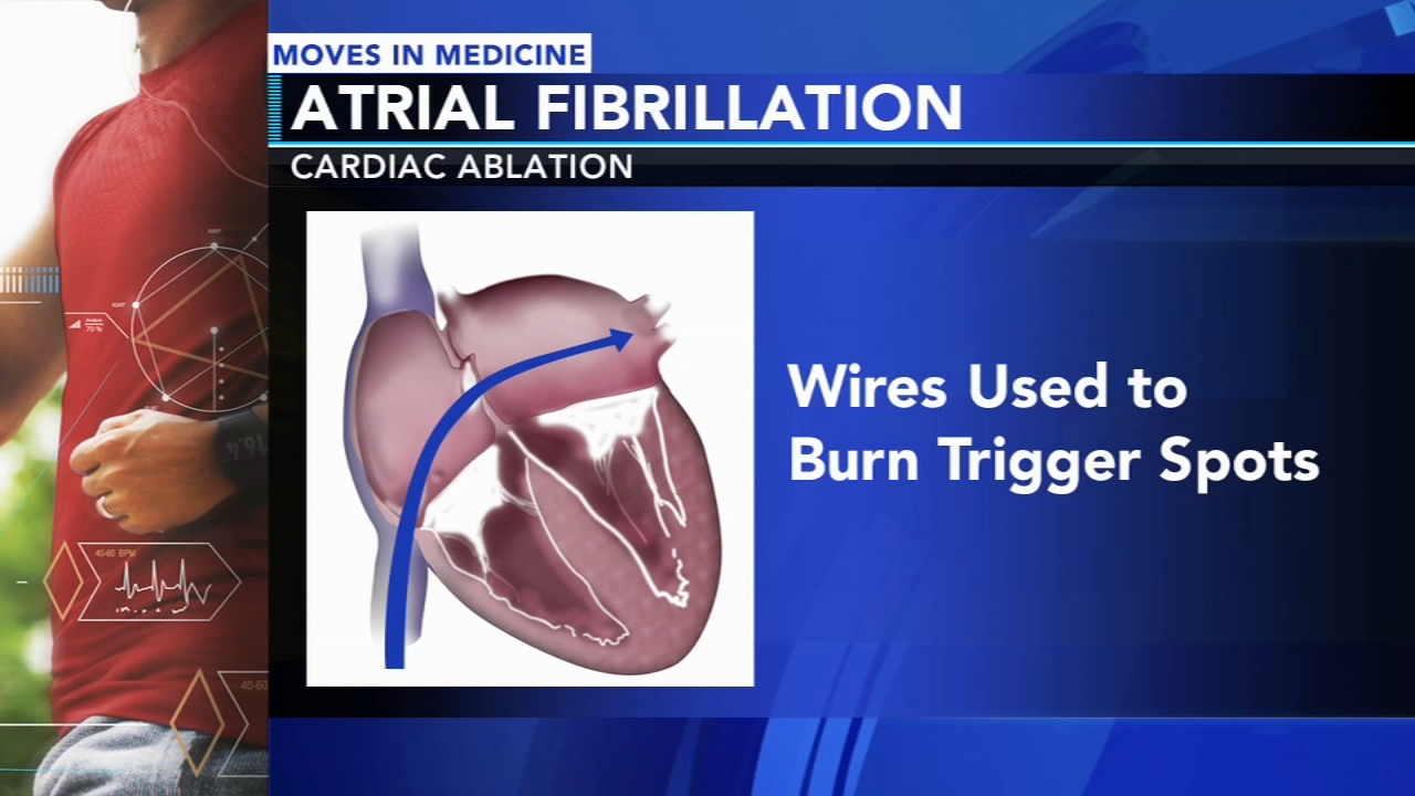 Moves in Medicine: Afib not limited to elderly