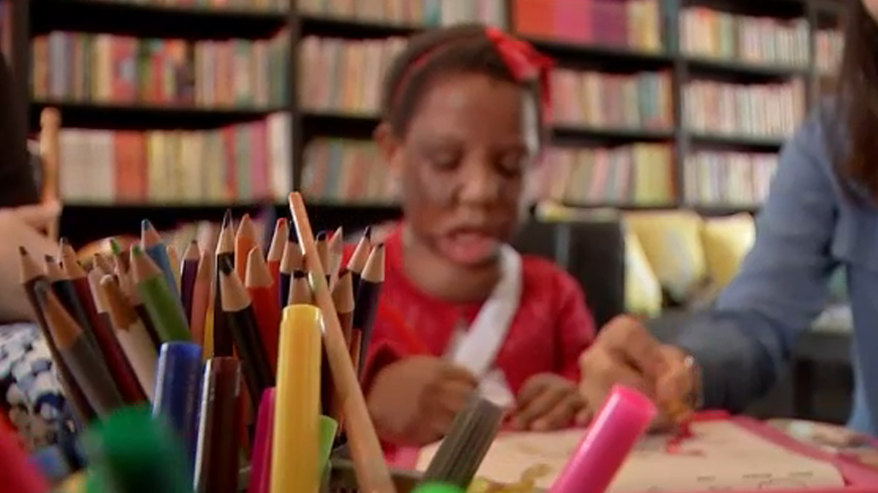 6-year-old abandoned burn victim gets medical treatment