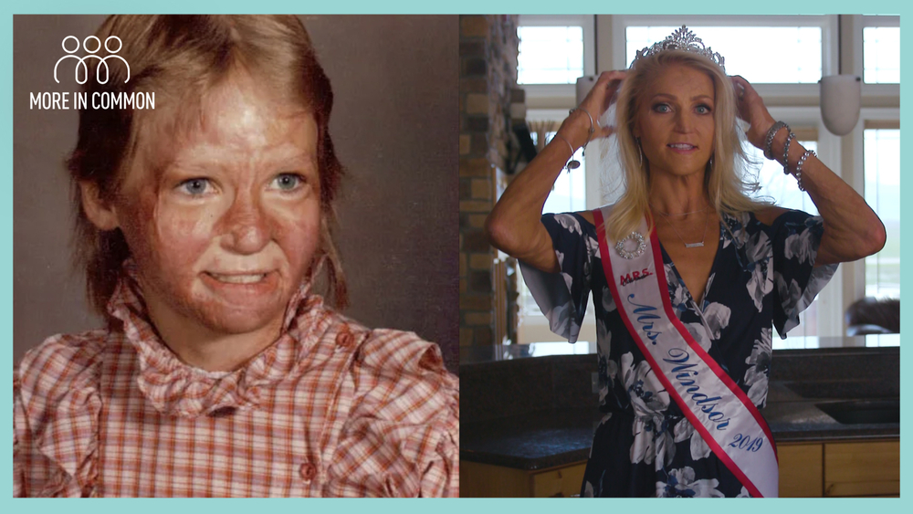 Burn victim becomes beauty pageant contestant