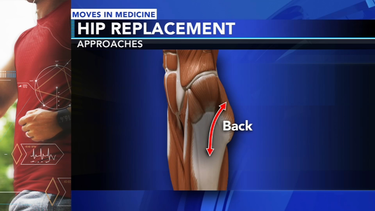 Moves in Medicine: New hip surgery techniques help ease pain, recovery time