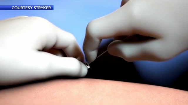 Doctors discover new technique that's revolutionizing stroke treatment