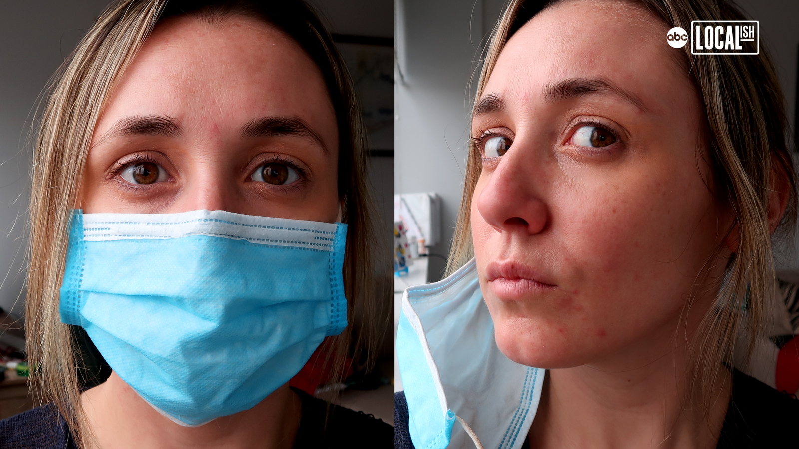 Coronavirus pandemic causing new skin issue 'MaskNe' aka Mask Acne