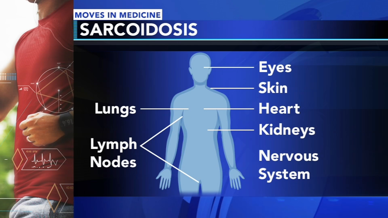 Finding the best medication balance for sarcoidosis | Moves in Medicine 