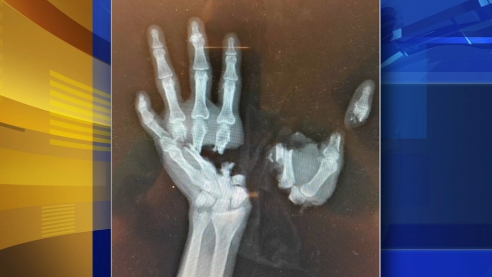 Hand surgeon warns against trend toward fireworks at home