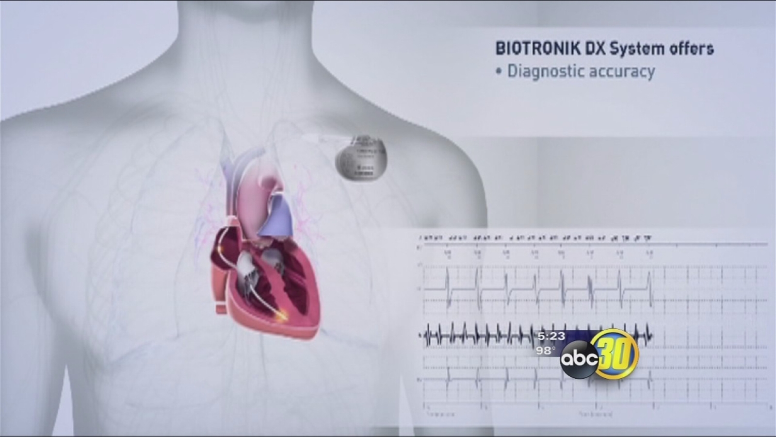 Bringing hearts back to life A new improved defibrillator ABC30 Fresno