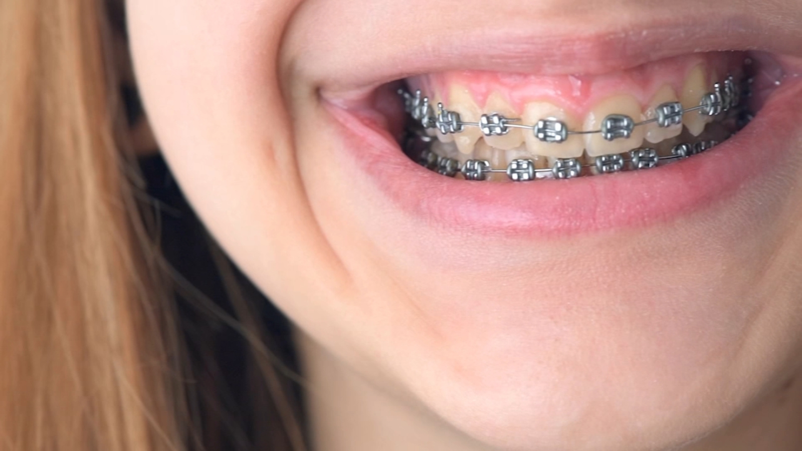 Braces Cost Charlotte NC  Webb & Goldsmith Orthodontics