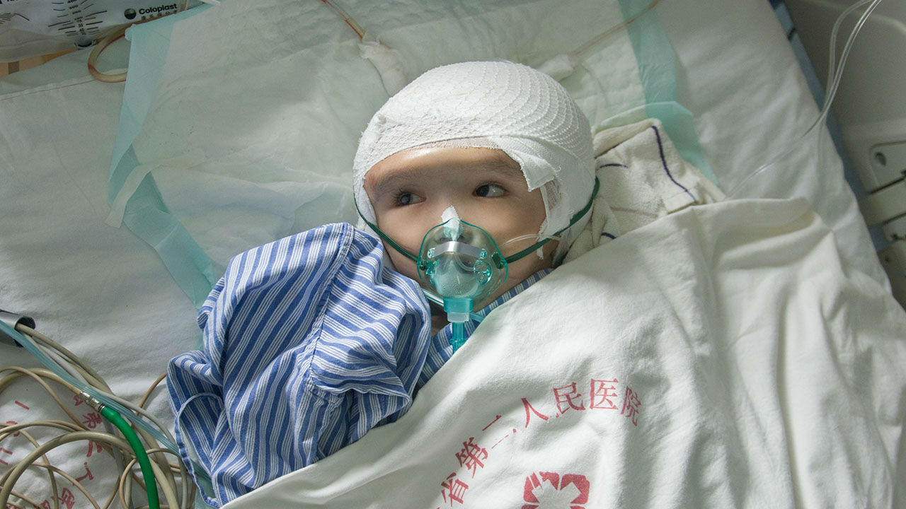 Three-year-old Hanhan's congenital hydrocephaly (with 85 percent hydrocephaly) made her skull three times bigger than average.