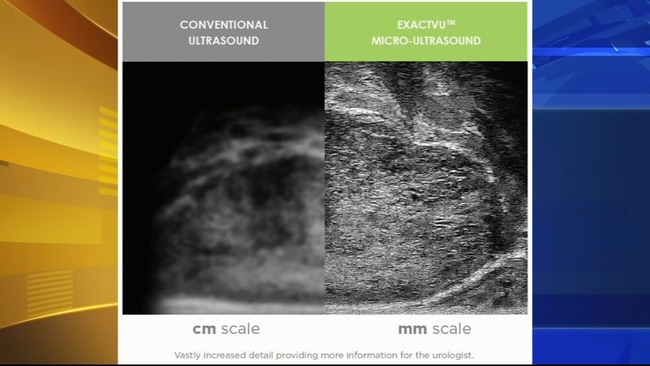 What you should know about post-menopausal bleeding: Causes and