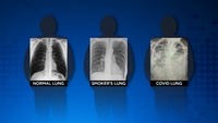 Smokers Lungs X Ray At Richard Brundage Blog Smokers Lungs X Ray At Richard Brundage Blog