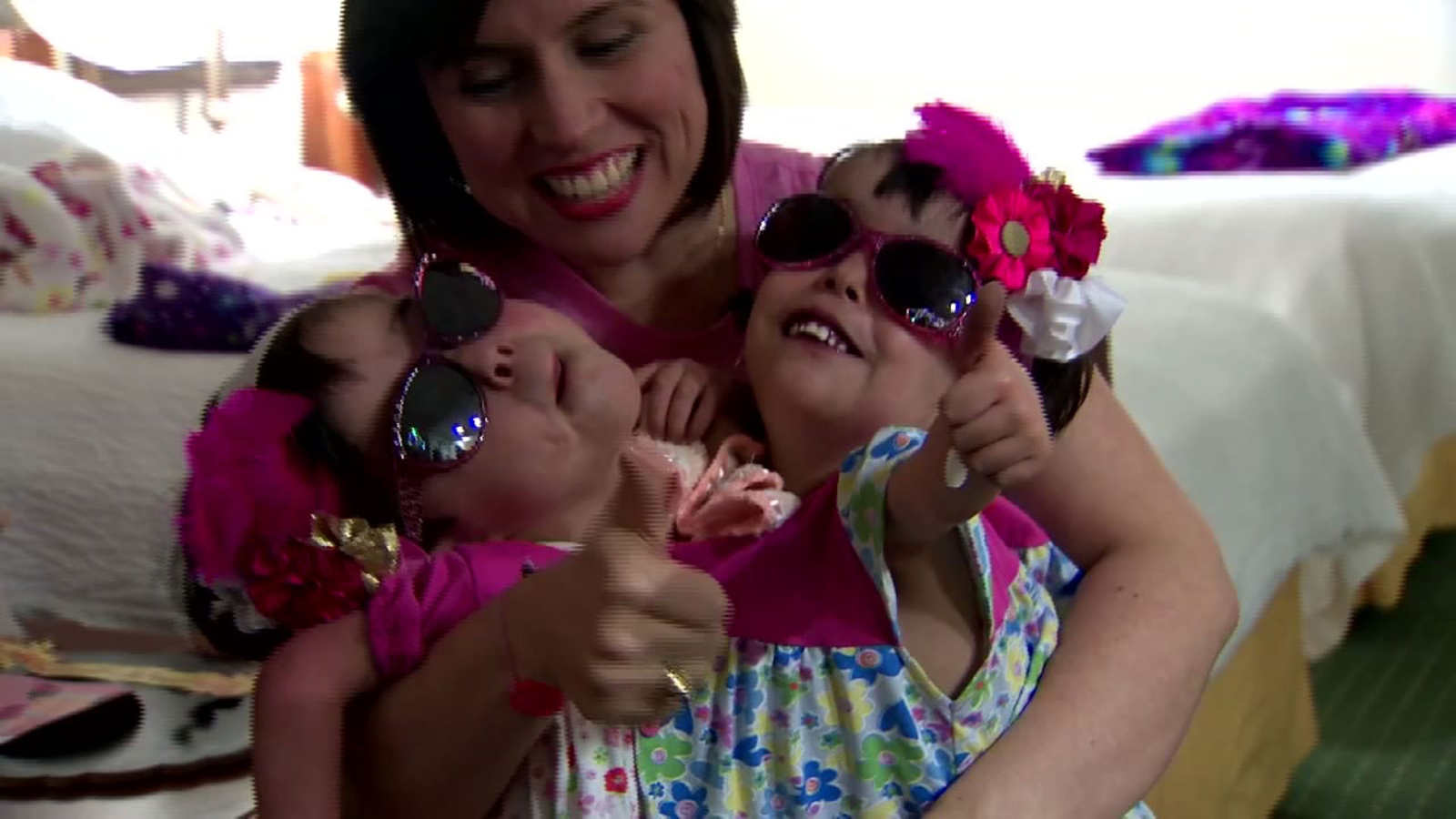 Houston Doctors Hope To Separate Conjoined Twins From Venezuela - Abc13  Houston Houston Doctors Hope To Separate Conjoined Twins From Venezuela - Abc13  Houston